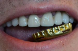 Ученые научат зубы самоизлечению